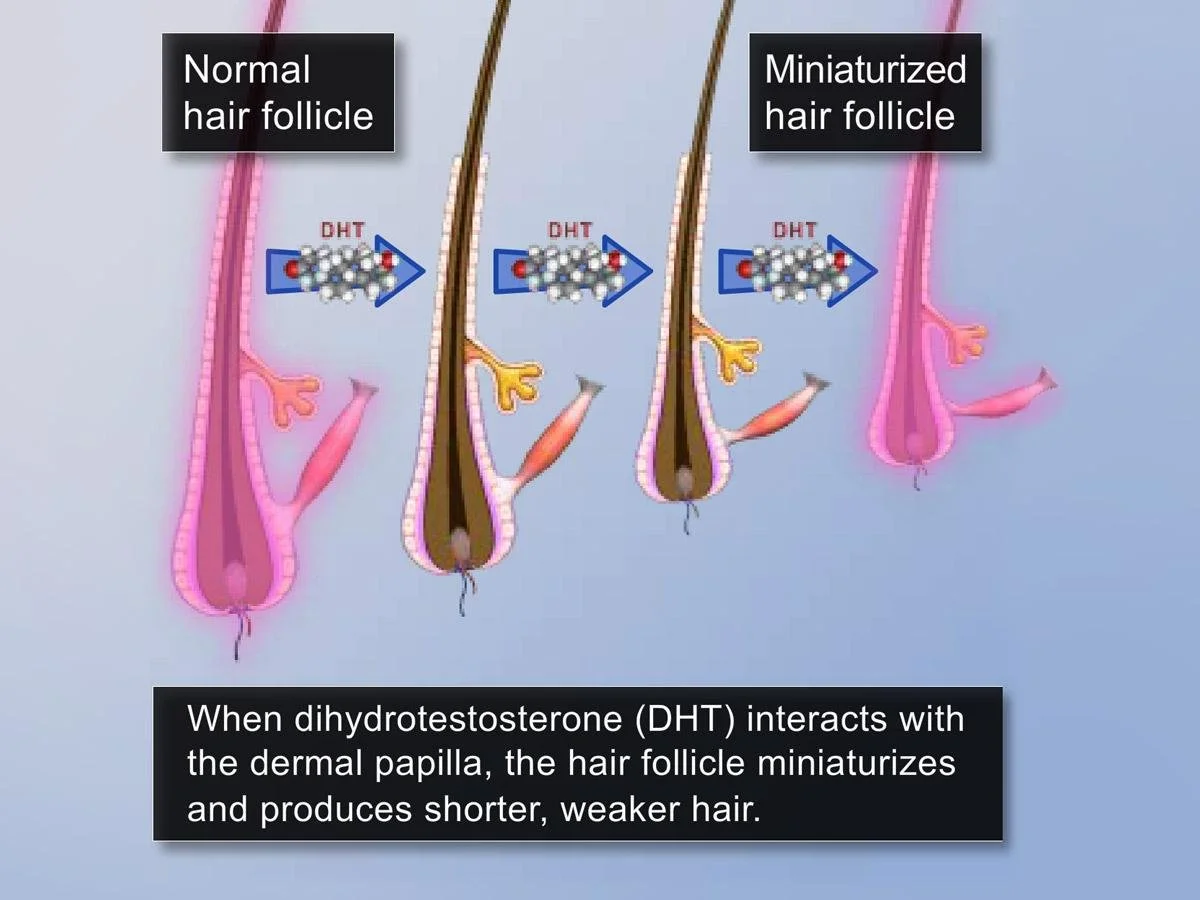 Hair Loss Solution Laser Hair Therapy — Advanced Hair Restoration