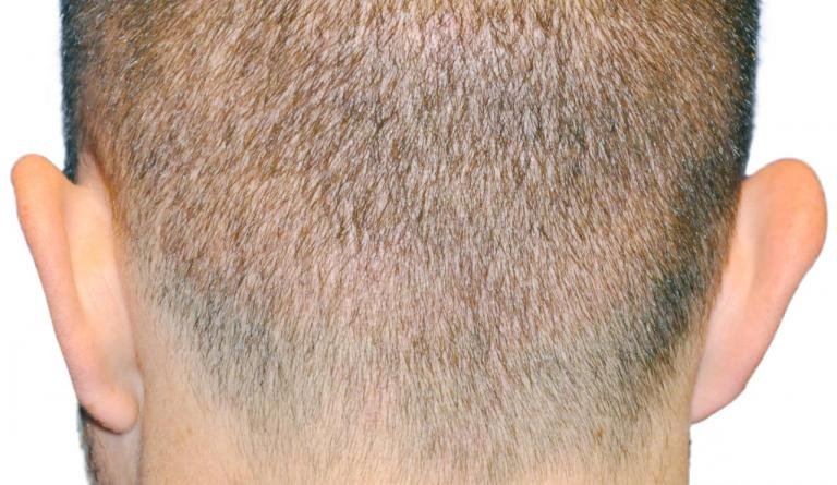 Hair Transplant Holes and Trypophobia  Causes and Treatments