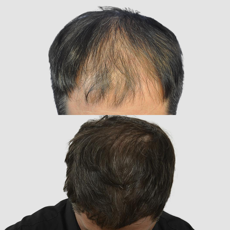 Male Gallery — Advanced Hair Restoration