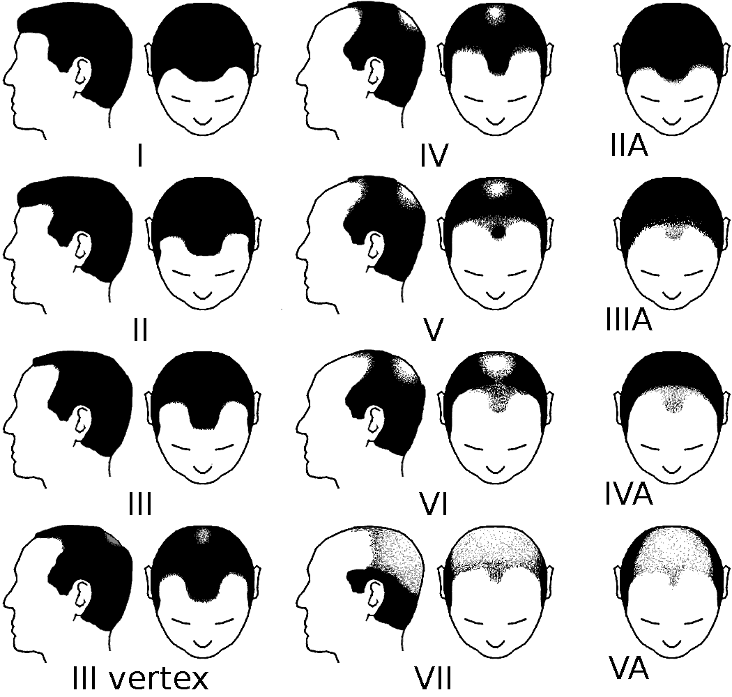 An image of the Norwood Scale, which is used to measure hair loss.
