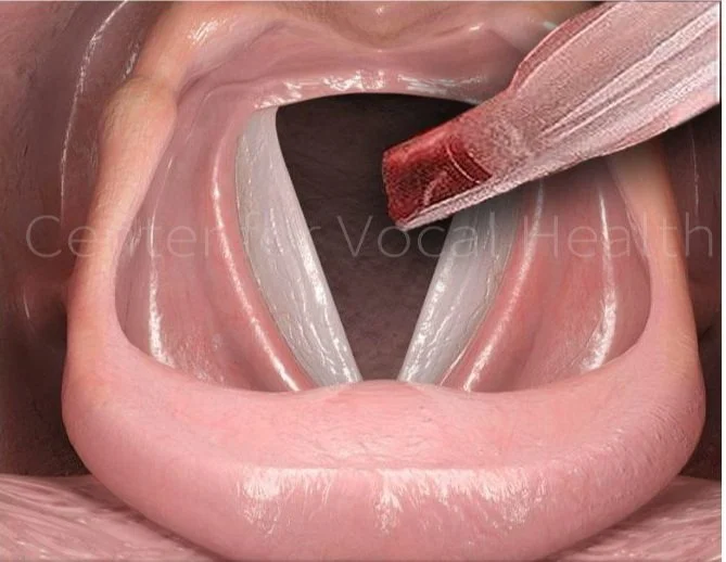 How does intubation affect your voice? — Center for Vocal Health ENT