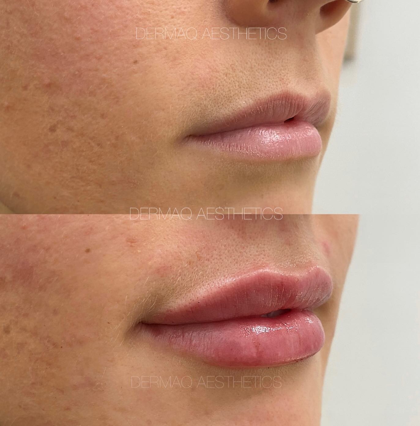 Soft and natural lip enhancement 🤍

💉 Treatment: 1ml of standard lip filler
⏰ Downtime: None. Mild bruising and swelling for 3-5 days following
⏳ Longevity: 6-8 months
👩🏼&zwj;⚕️ Injector: Madeline
📱 Bookings: dermaq.co or DM
-
-
-
-
-
#dermalfil