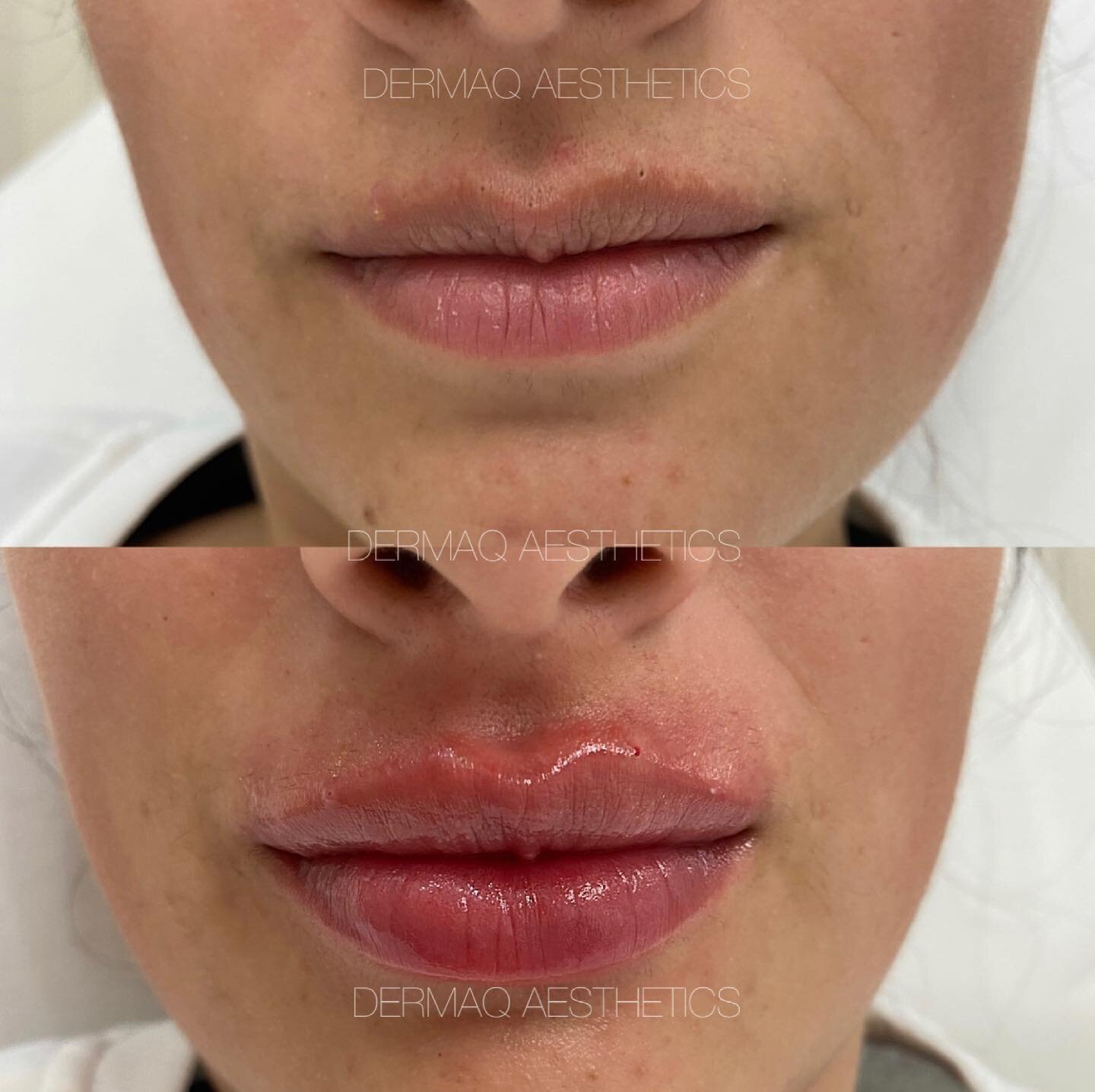 Subtle lip enhancement and definition of the border 🤍

💉 Treatment: 0.8ml of premium lip filler
⏰ Downtime: None. Mild bruising and swelling for 3-5 days following
⏳ Longevity: 9-12 months
👩🏼&zwj;⚕️ Injector: Madeline
📱 Bookings: dermaq.co or DM