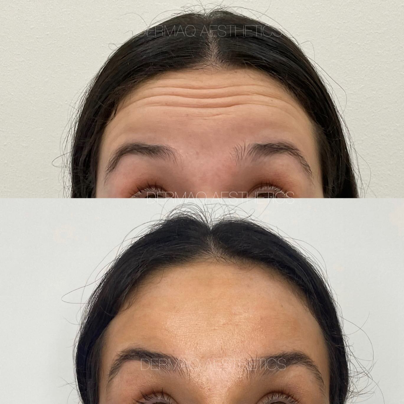 A sprinkle of anti-wrinkle to stop those pesky forehead lines from sticking around ✨ prevention is the key!

💉 Treatment: forehead anti-wrinkle injections 
⏰ Downtime: None
⏳ Longevity: 3-4 months
👩🏼&zwj;⚕️ Injector: Madeline
📱 Bookings: dermaq.c