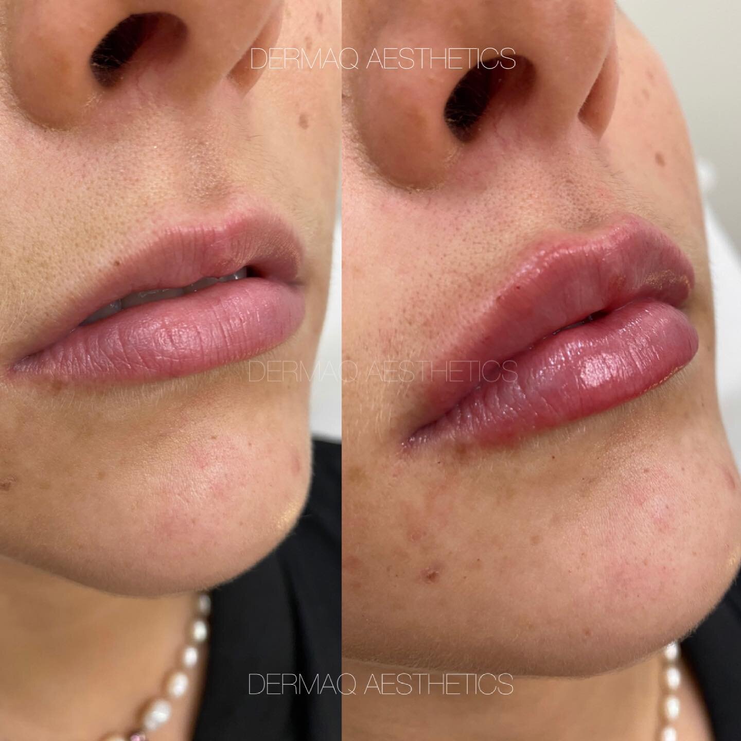 A little upper lip enhancement for your Thursday morning 🤍 the &lsquo;m&rsquo; shaped upper lip can be difficult to balance and &lsquo;fill in&rsquo;, but this transformation is absolutely stunning!
-
-
-
-
#dermalfiller #lipfiller #lipflip #cosmeti