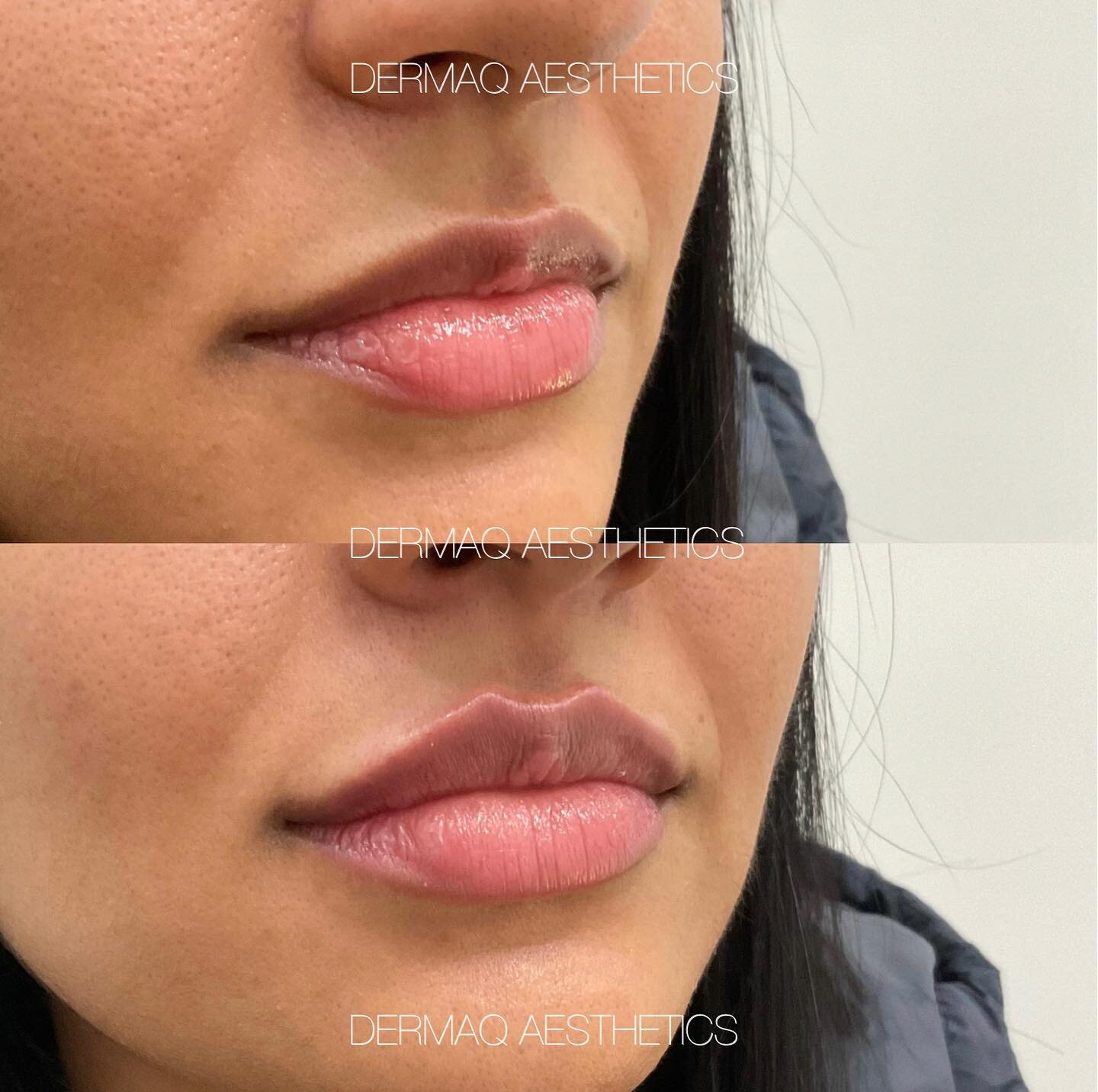 Natural lip enhancement ✨

💉 Treatment: 0.5ml of premium lip  filler
⏰ Downtime: None. Mild bruising and swelling for 3-5 days following
⏳ Longevity: 9-12 months
👩🏼&zwj;⚕️ Injector: Madeline
📱 Bookings: dermaq.co or DM
-
-
-
-
-
#dermalfiller #li