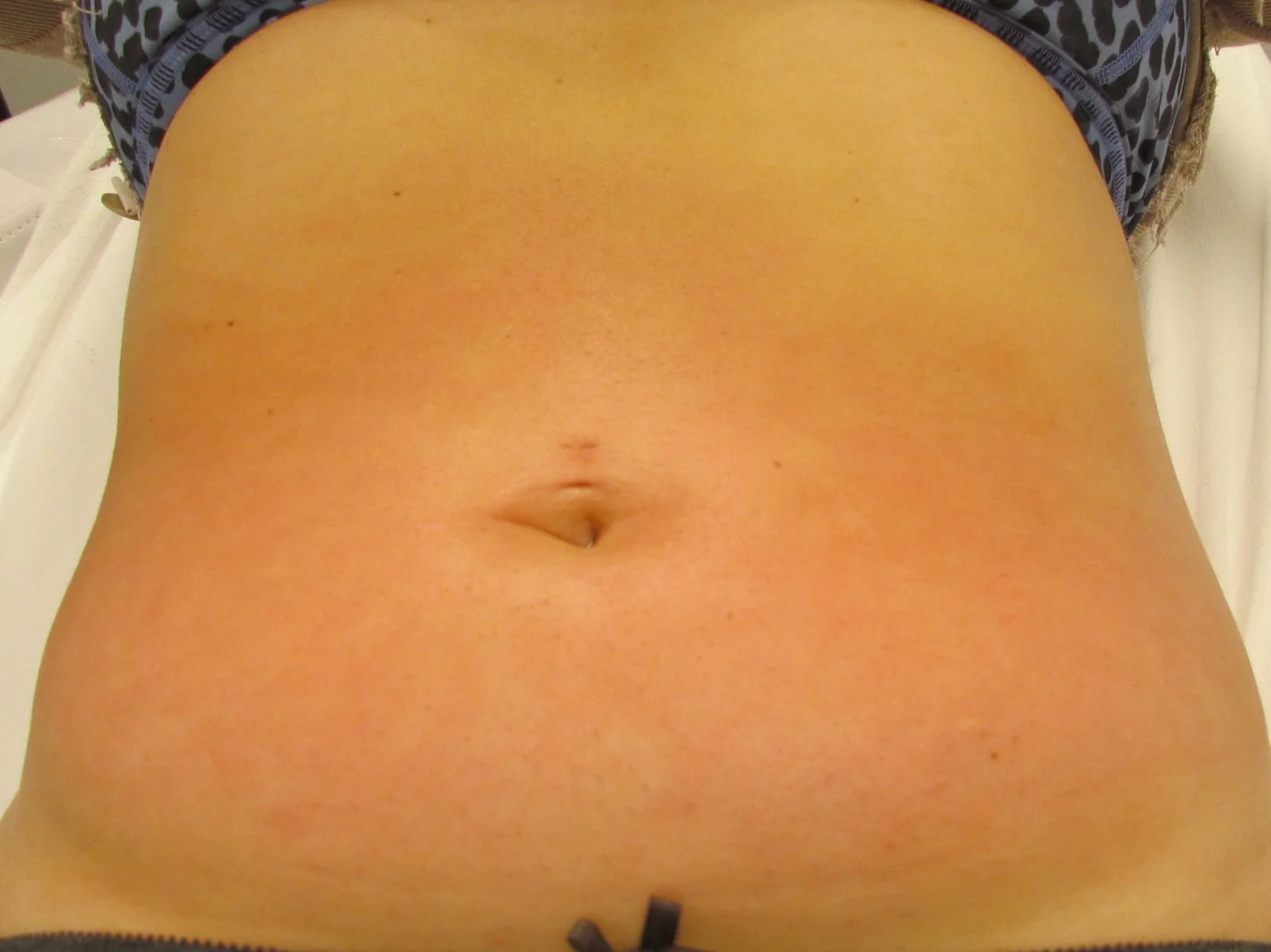 After 1st Teatment- Body Tightening