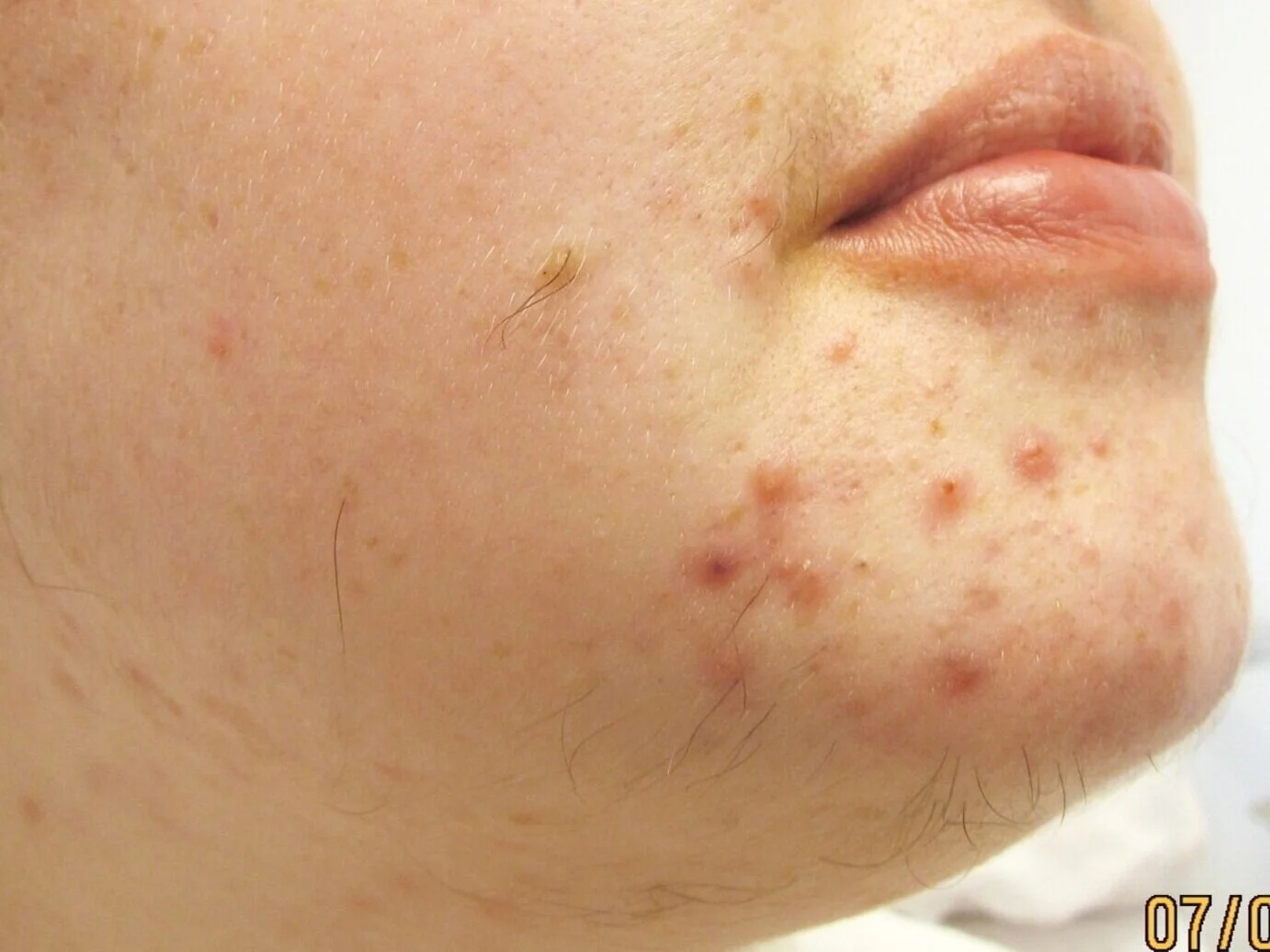 Hair Removal-Before Treatment