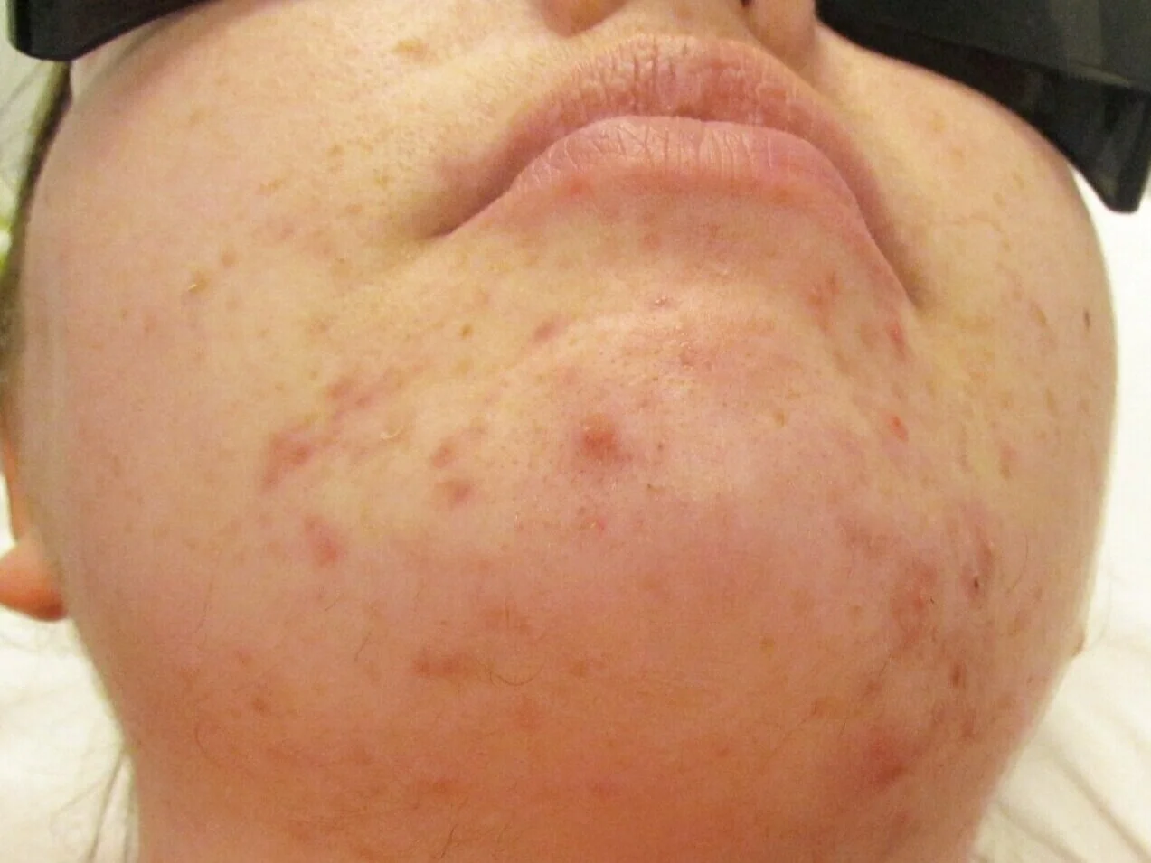 Laser Hair Removal- After the 1st treament