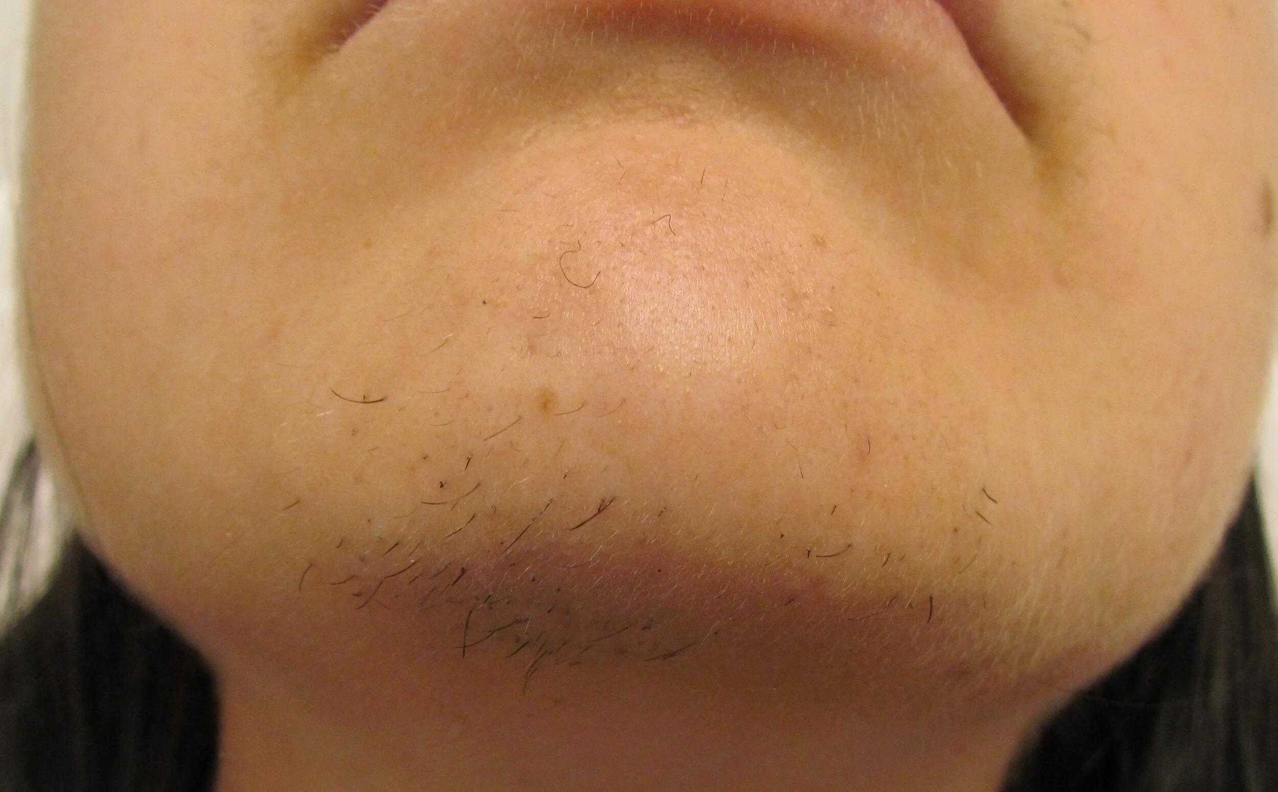 Before  1st treatment.JPG