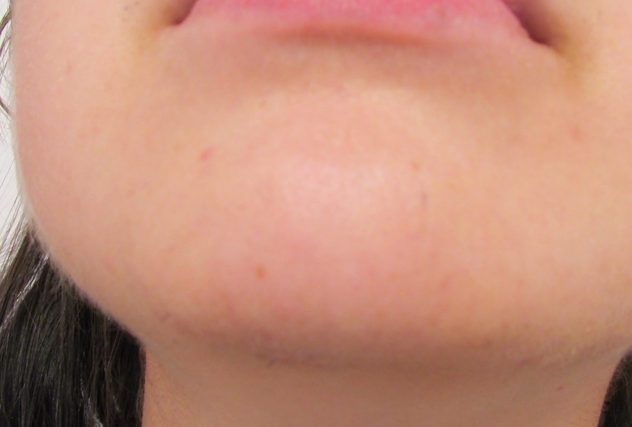 Before second treatment (Chin).JPG
