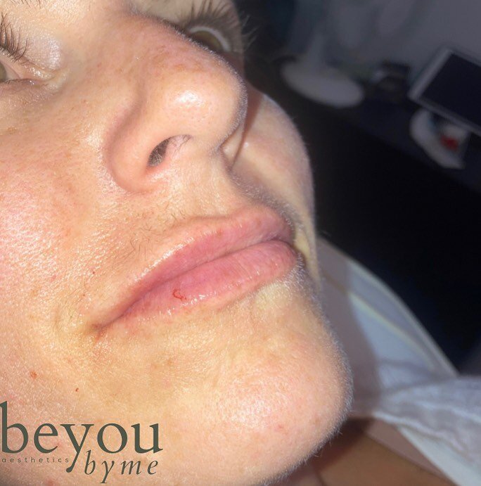 Filler freshen up 🤍

Natural appearance is my aim 👌🏼

#essexfillers #lipfillersessex #chelmsfordbeauty #fillerfreshenup #aesthetics #prescriber