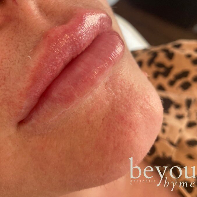 Another freshen up 😍👄💉

#midwife #aestheticspractitioner #chelmsfordbeauty #lipfiller #chelmsfordlipfiller #teoxane