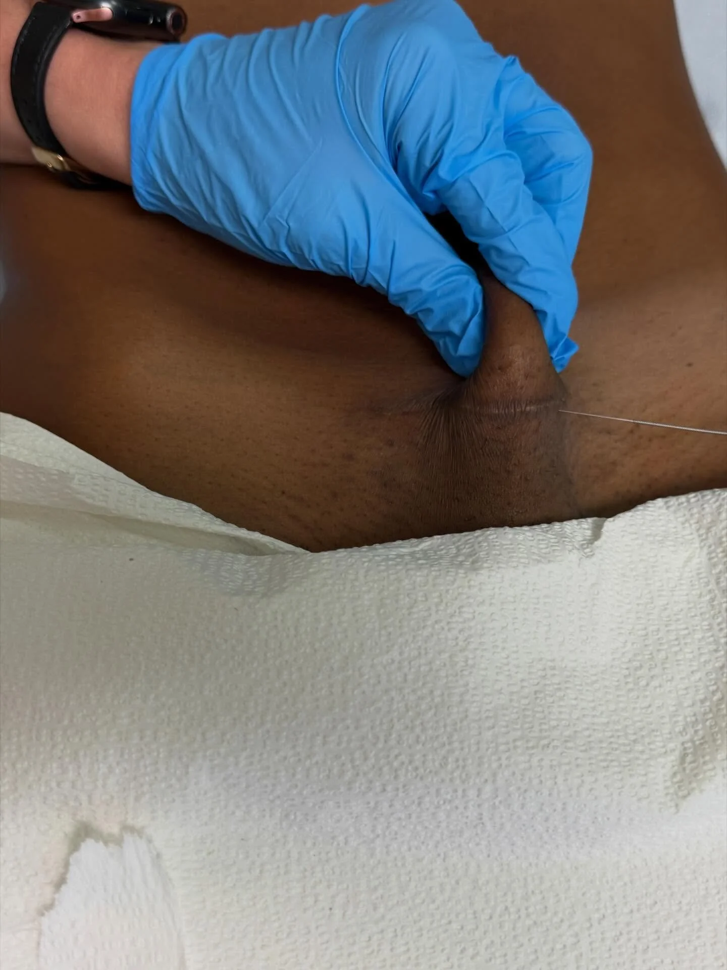 A couple times a month, our team gets together for clinical education. Sometimes it&rsquo;s a journal club, other times is a video, podcast discussion or case conversation. This time was an awesome dry needling workshop for c-section scars led by @je