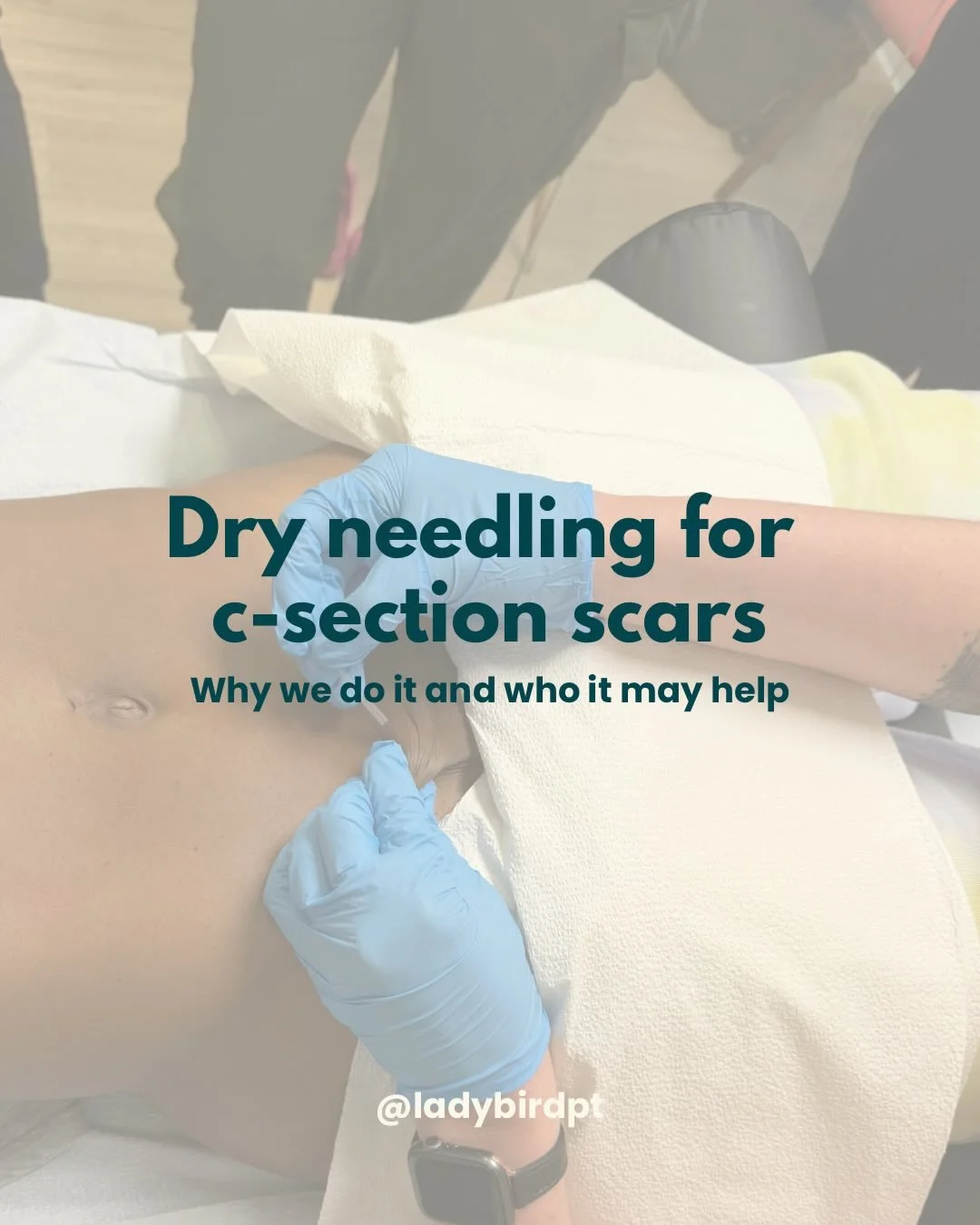 Dry needling isn&rsquo;t the first intervention we reach for when someone comes in for c-section scar concerns, but in certain cases it can be an incredible helpful adjunct for treatment.

If you&rsquo;ve been stretching, doing scar massage, moving y