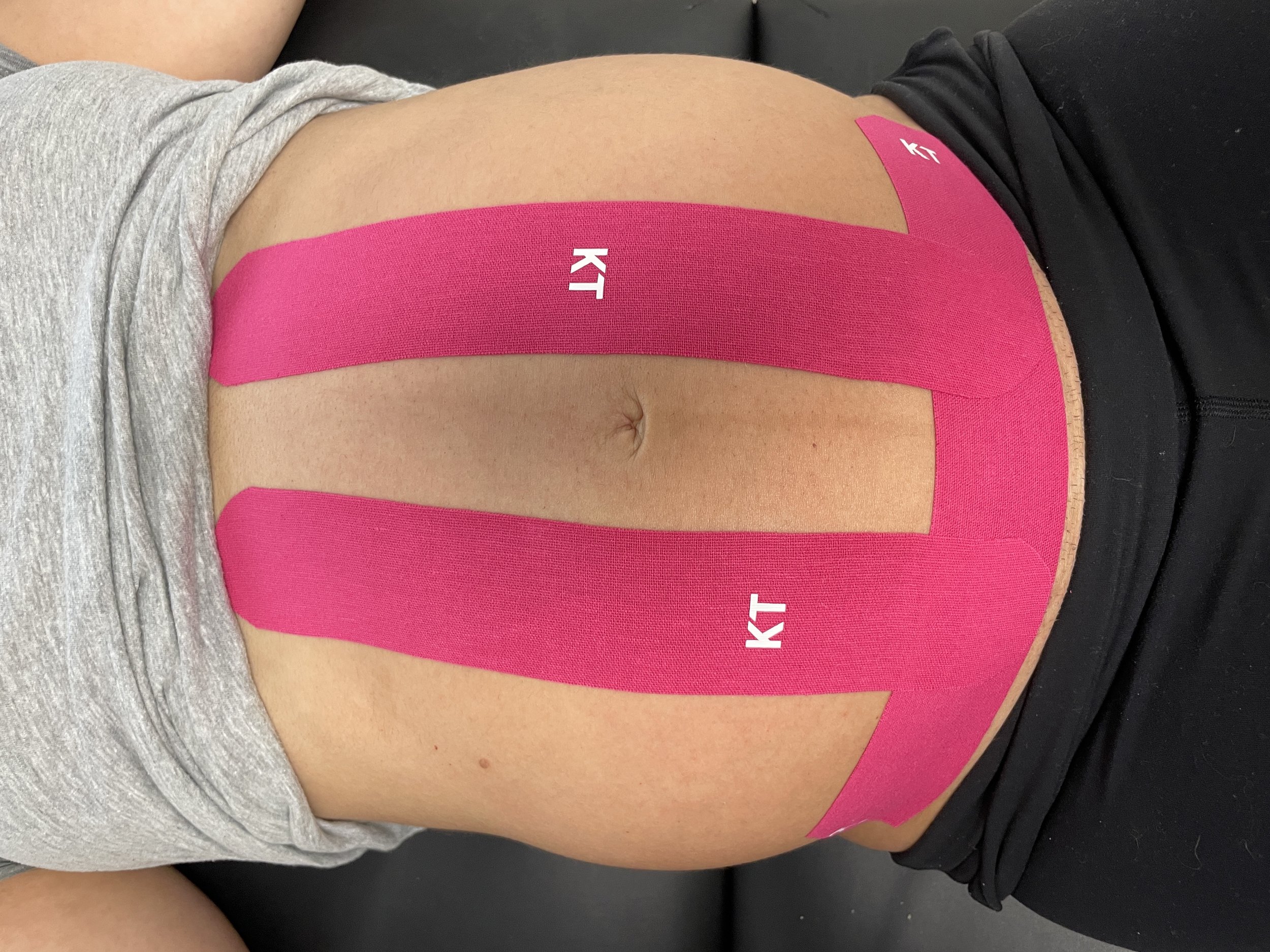 Kinesiology taping (KT) for pregnancy has many benefits. It's a