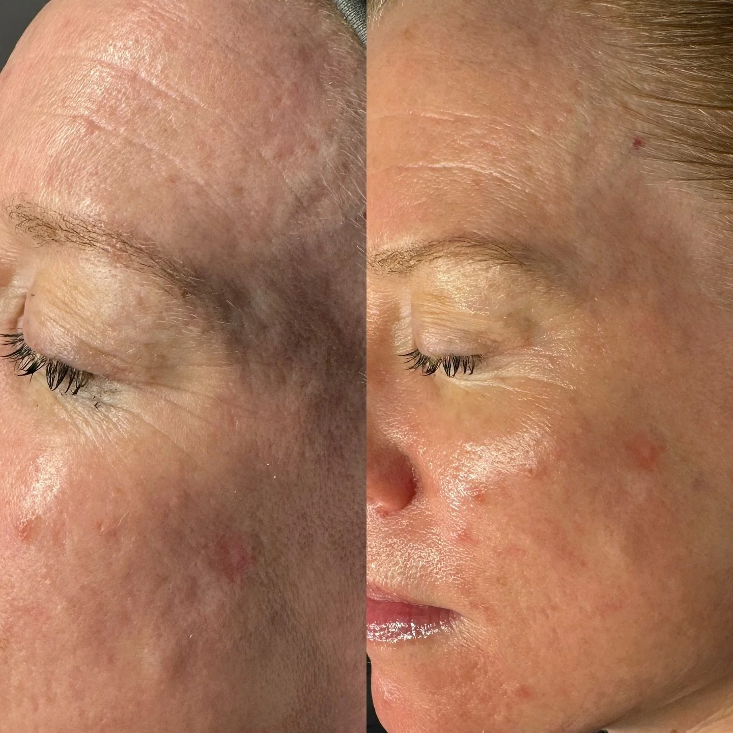 Looking for real results without the traditional &ldquo;downtime&rdquo;? Say hello to your new best friend,  @cosmedix_ Invigorate Peel 🤌🏼✨

A medium depth chemical peel formulated to yield insane results with NO downtime! 

✨PEEL DETAILS✨
Improves