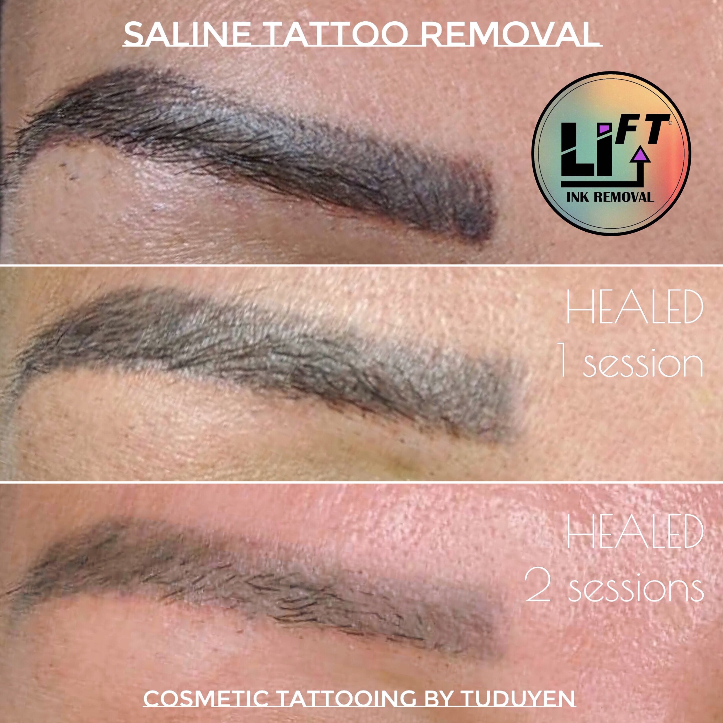 What is Saline Tattoo Removal Botched Ink solution to lift  lighten   Botched Ink COM