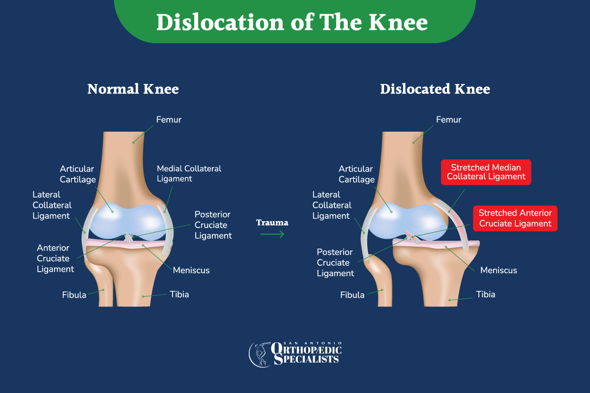 Dislocated Knee Treatment San Antonio Orthopaedic Specialists