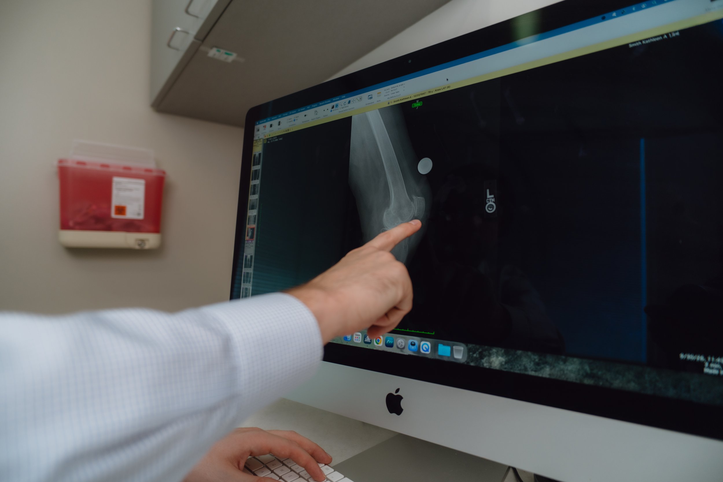 Knee ligament reconstruction for improved joint stability at San Antonio Orthopaedic Specialists in San Antonio, Texas