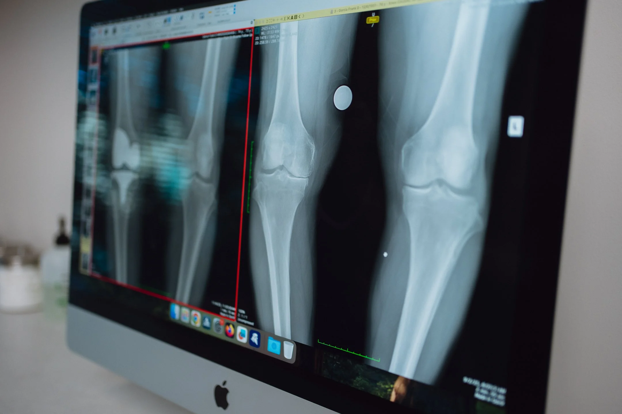 Knee arthritis treatment in San Antonio