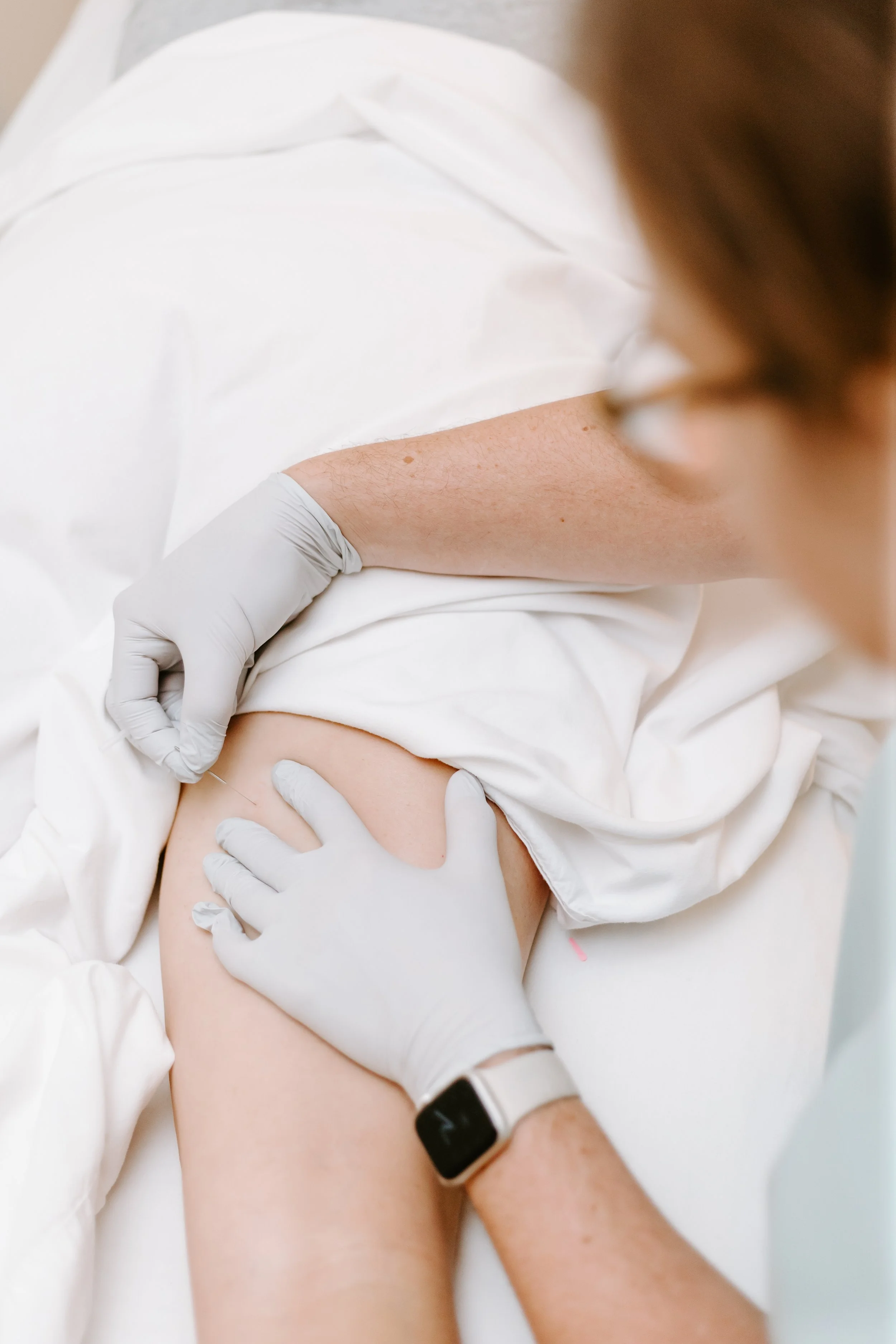 Pelvic Floor Dry Needling: A Powerful Tool for Pain Relief and Recovery