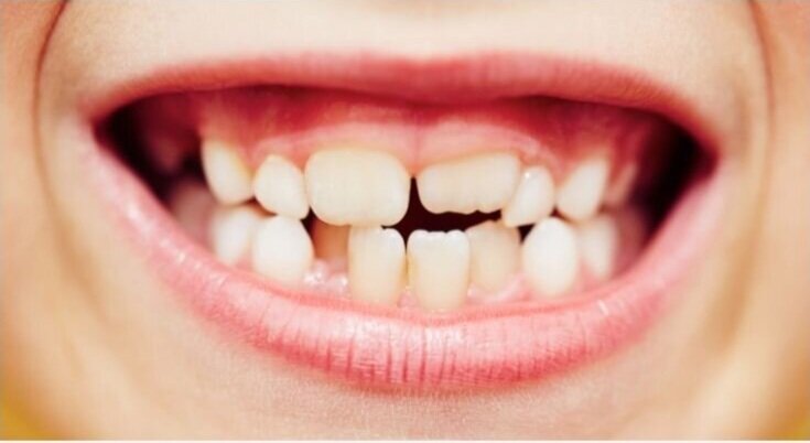 Rough Edges on Your Front Teeth?