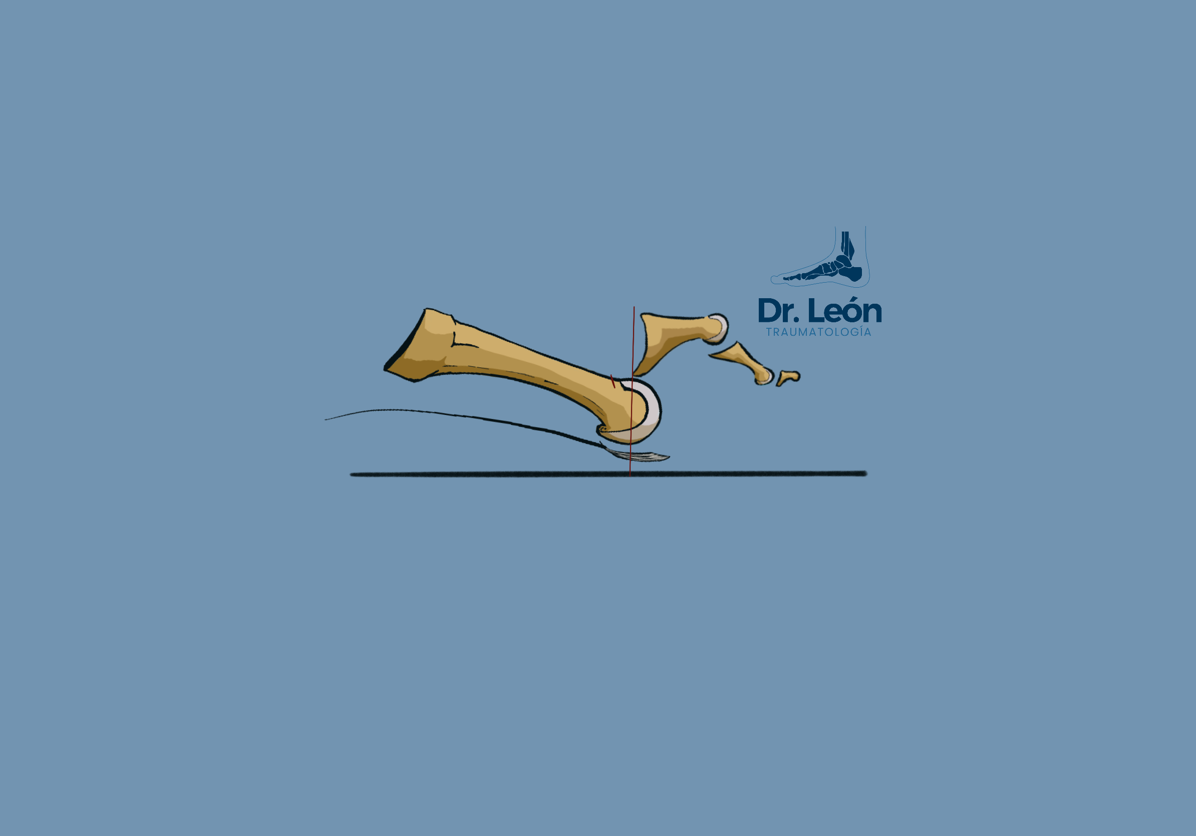 Toe Subluxated above M2 head