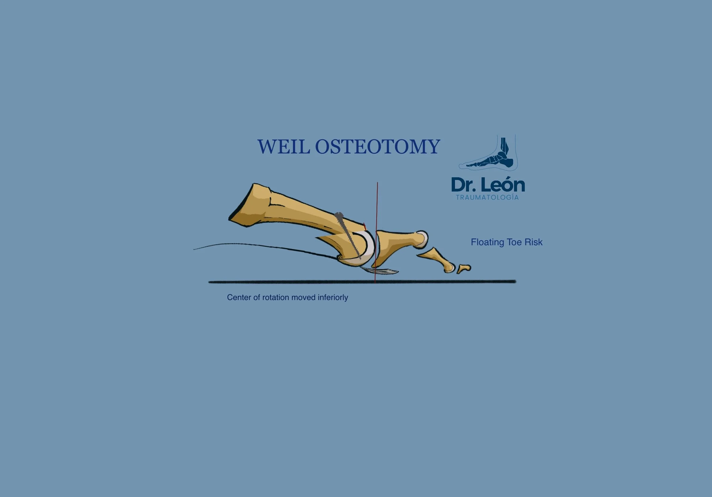 Weil Osteotomy of the MTT