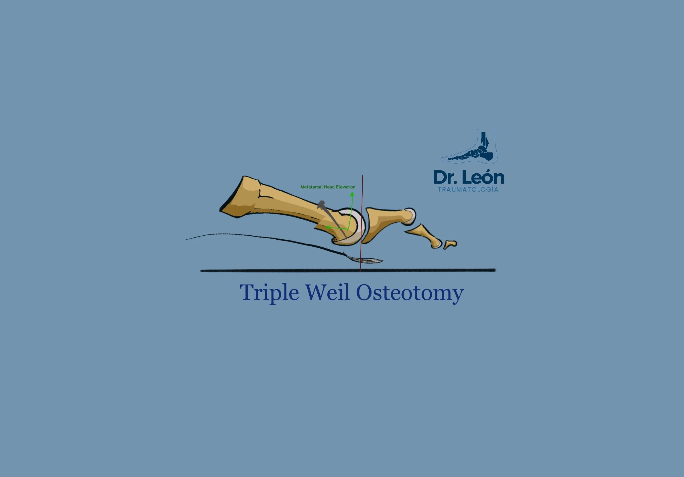 TRIPLE WEIL OSTEOTOMY - Maceira’s Osteotomy