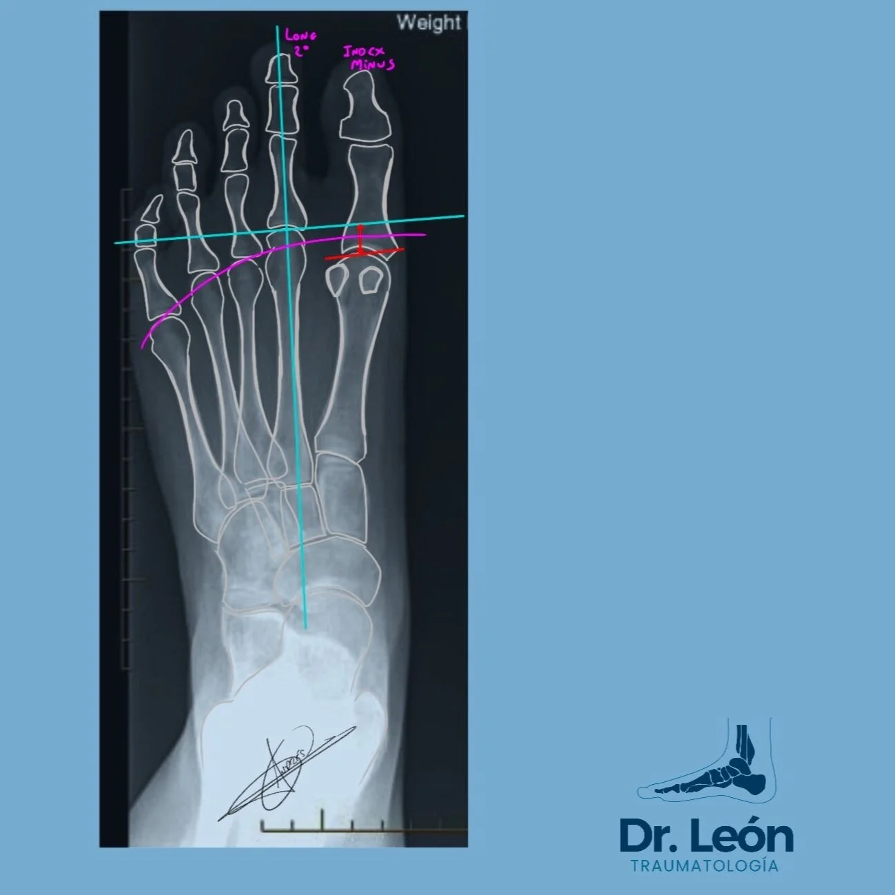 Index minus + long 2nd metatarsal - At risk of PP injury