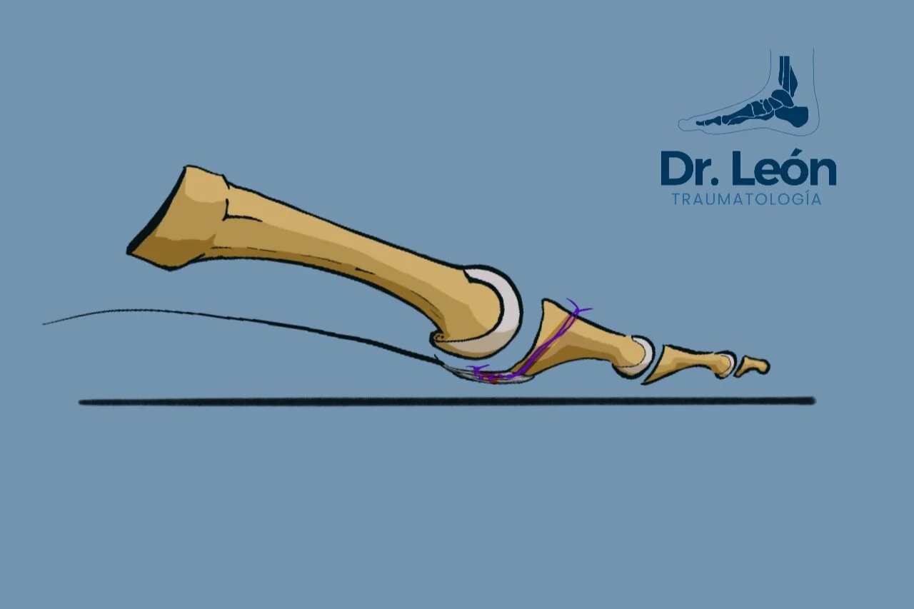 Plantar Plate Review of newest evidence. — Doctor Andrés León