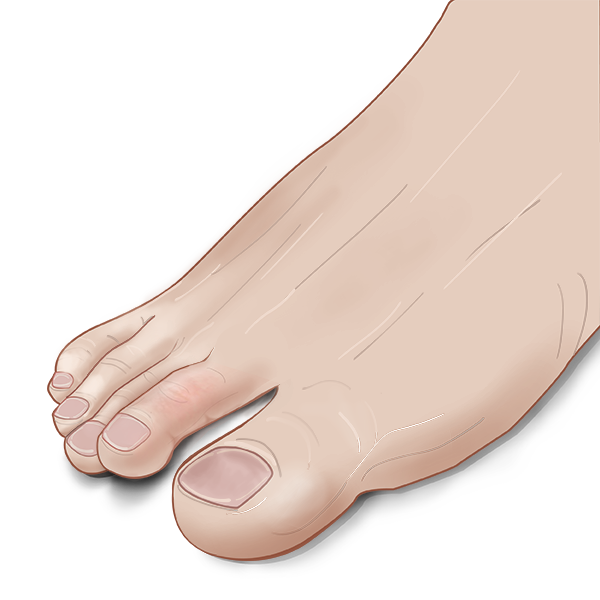 Floating toe