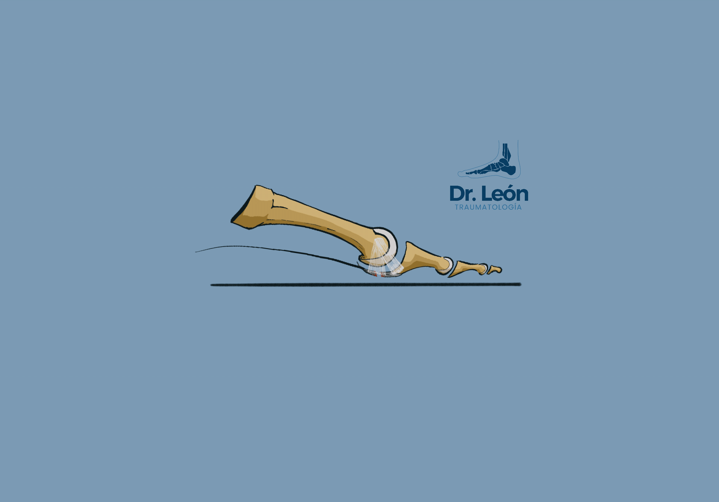 Plantar Plate Review of newest evidence. — Doctor Andrés León