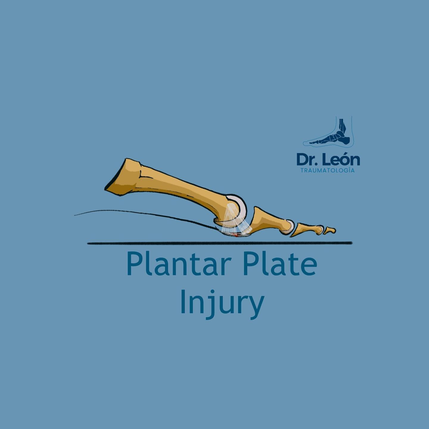 Lesi&oacute;n de Placa Plantar #footsurgery  #plantaplate #metatarsalgia #cirugiapie https://traumatologiadrleon.com/blog/plantarplatepearls