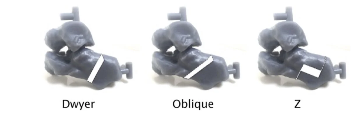 Pfeffer GB, Michalski MP, Basak T, Giaconi JC. Use of 3D Prints to Compare the Efficacy of Three Different Calcaneal Osteotomies for the Correction of Heel Varus.