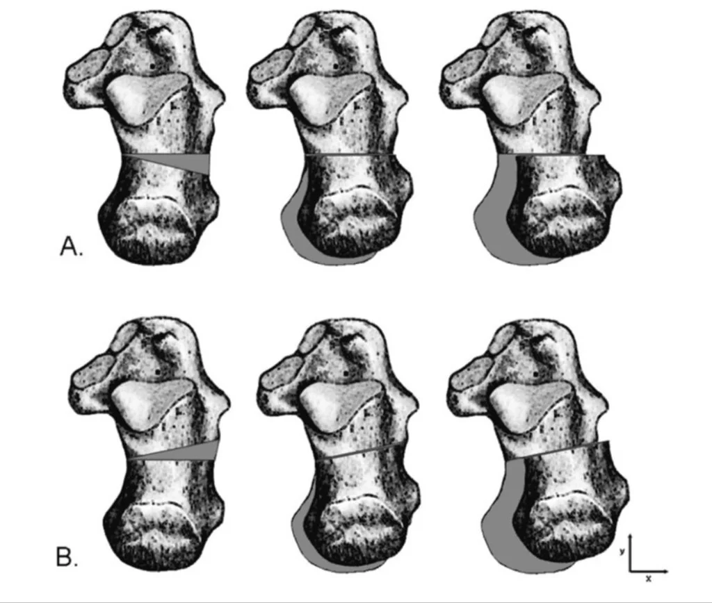 Original article osteotomy of the calcaneus