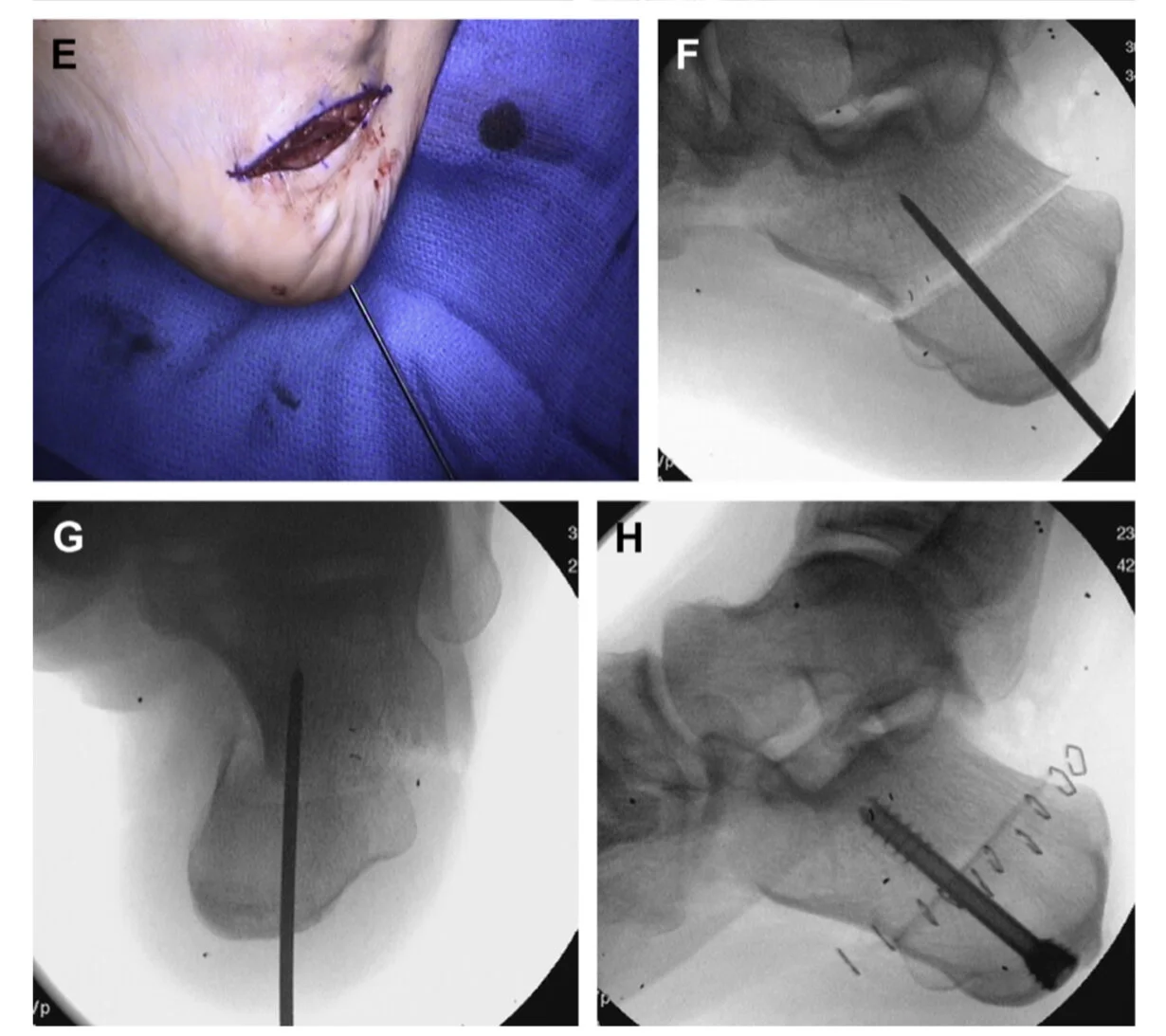 Clinical case representing medializating osteotomy