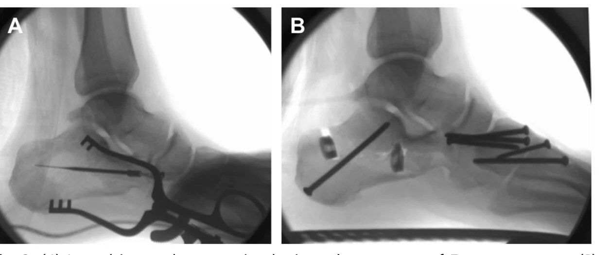 Calcaneal Osteotomies Tips and Tricks — Doctor Andrés León Consulta