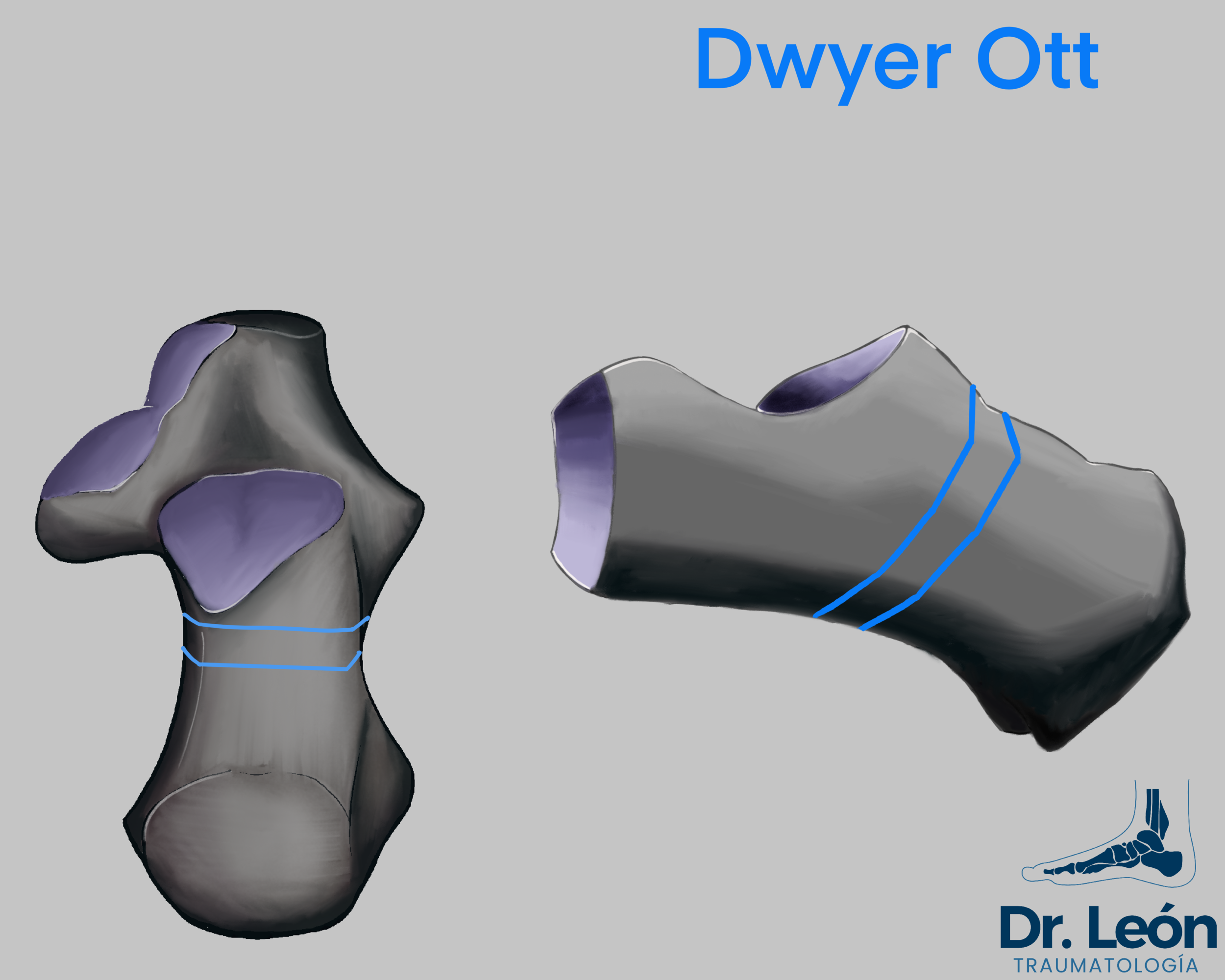 Dwyer osteotomy - proximal osteotomy, longer lever arm. More correction