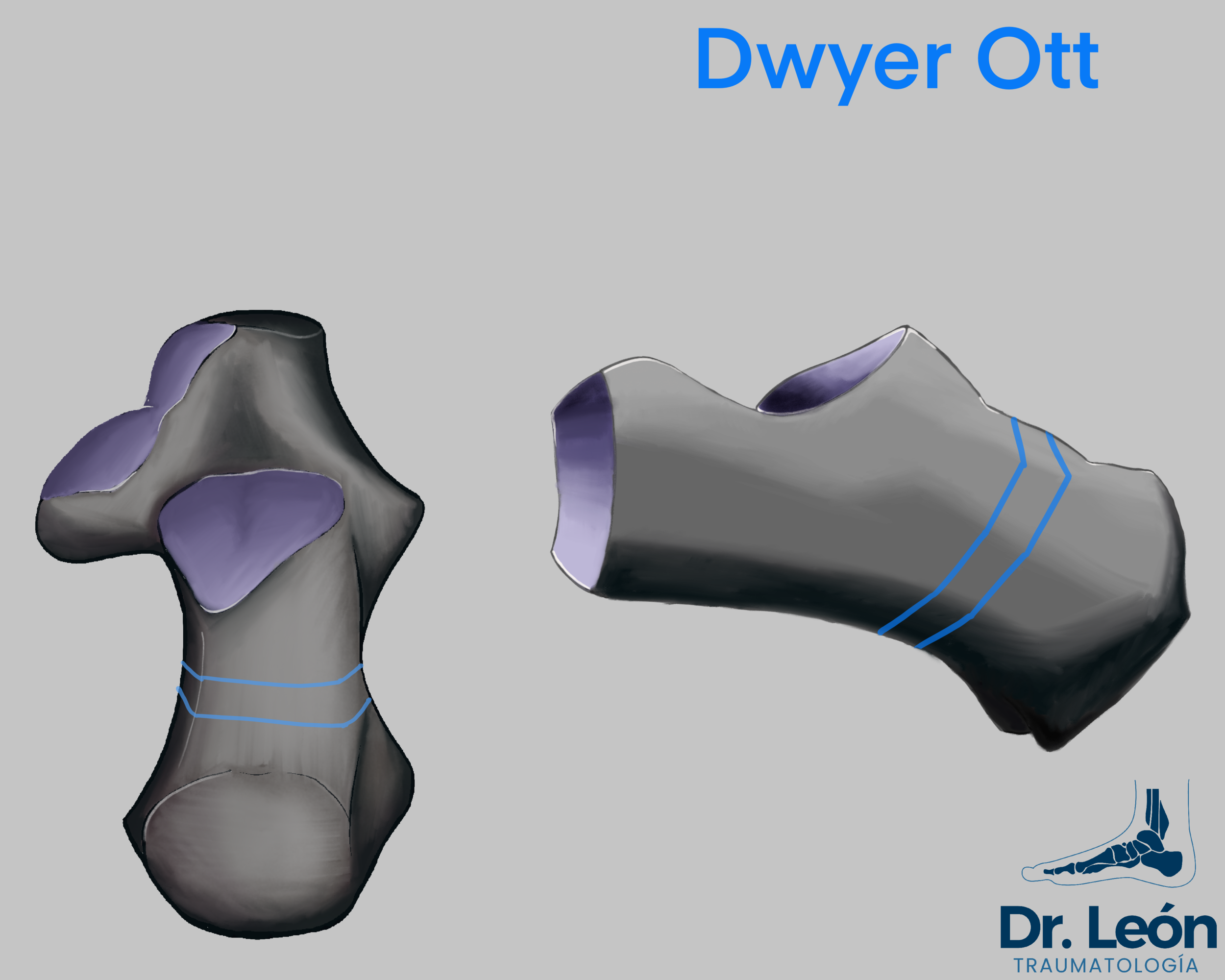 Dwyer osteotomy - More distal osteotomy = lesser lever arm = less correction
