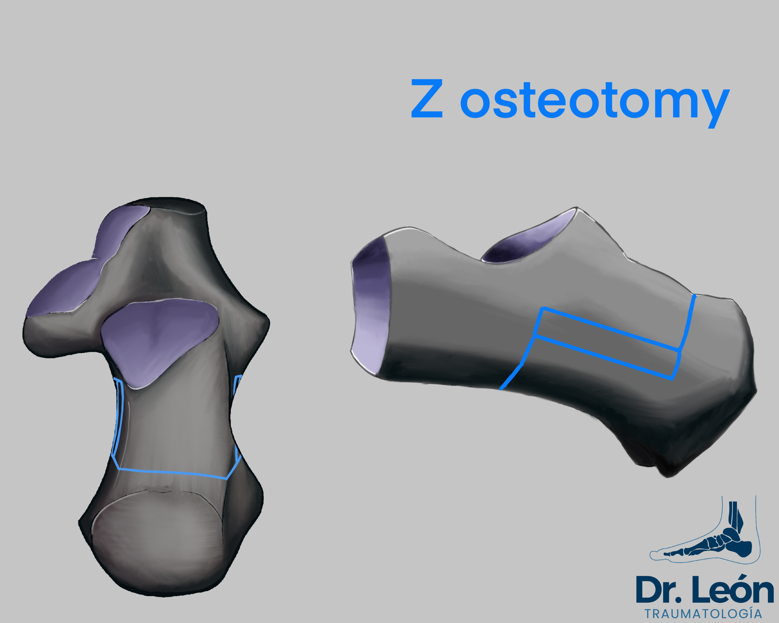 Z osteotomy, inspired by scarf osteotomy of M1 can be made to correct complex deformities of the calcaneus with a single approach