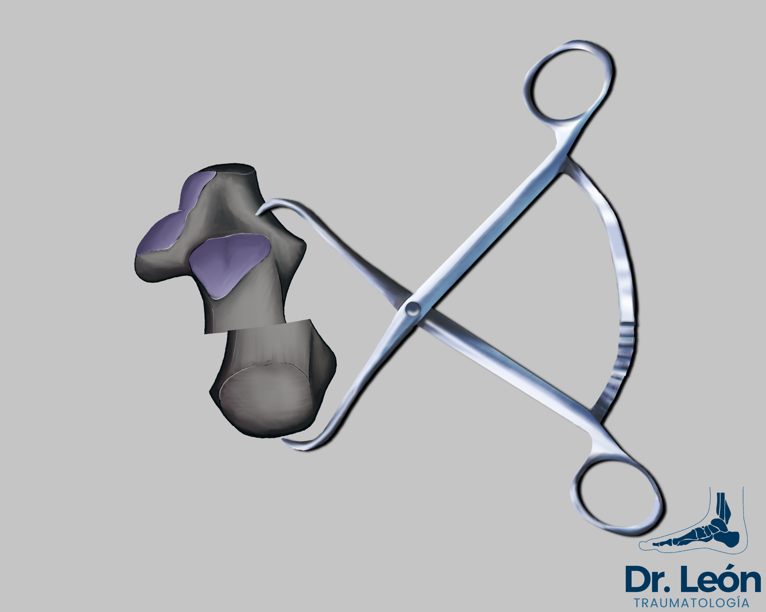 Codevilla bone forceps used to maintain reduction