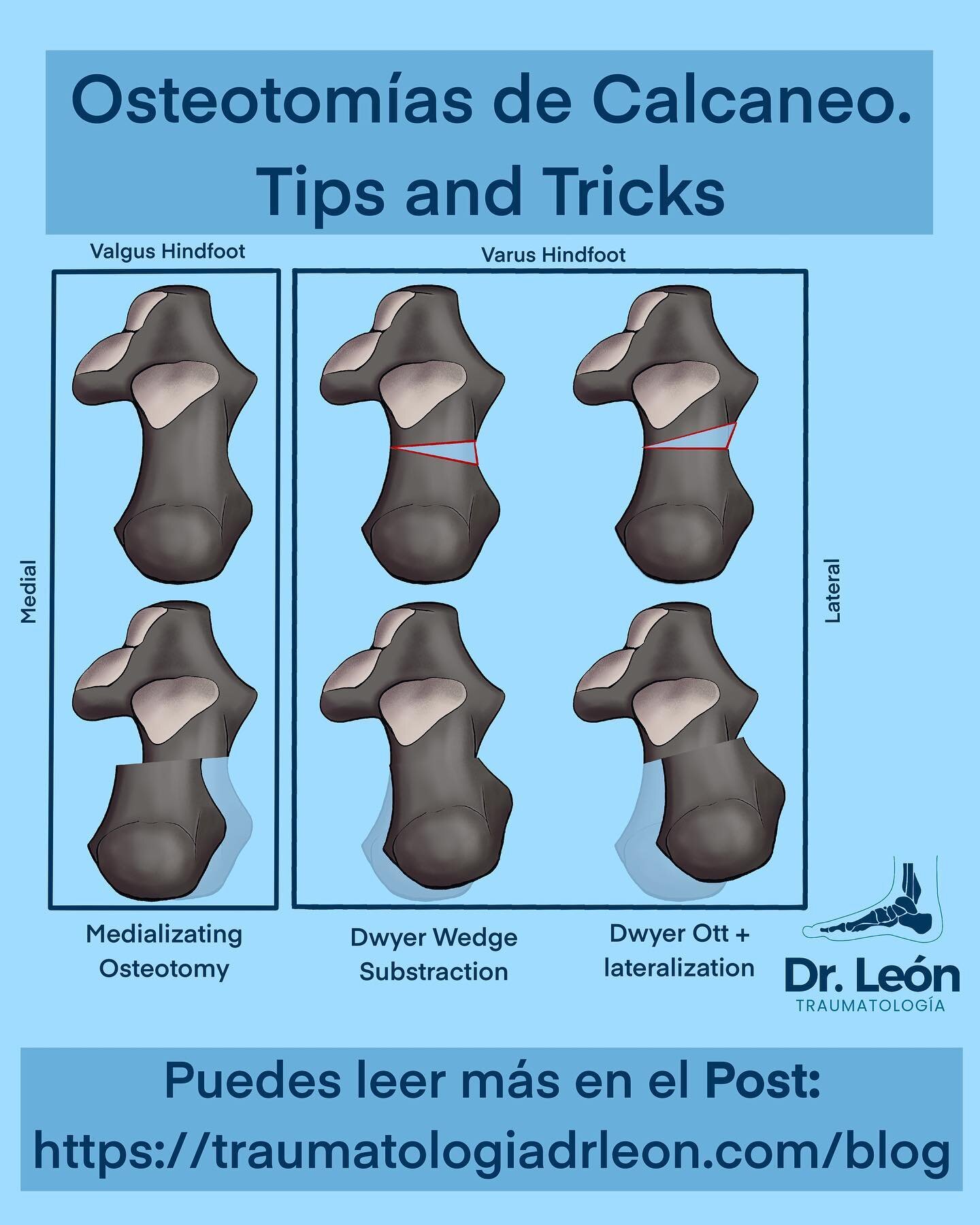 Nuevo Blog Post. Surgical tips and Tricks for calcaneal ostotomies. Hope you like it 👍 https://traumatologiadrleon.com/blog/calcaneal-osteotomies-surgicaltipsandtricks