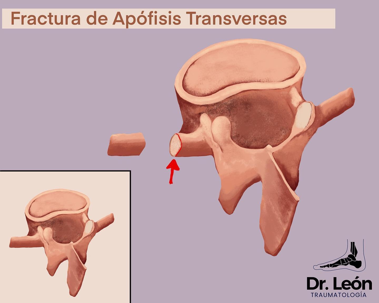 Divulgaci&oacute;n Traumatol&oacute;gica 🔨 aprende de las fracturas vertebrales lumbares mas frecuentes y a menudo infradiagnosticadas.
Sigue leyendo el resto del post en el Blog https://traumatologiadrleon.com/divulgacionblog