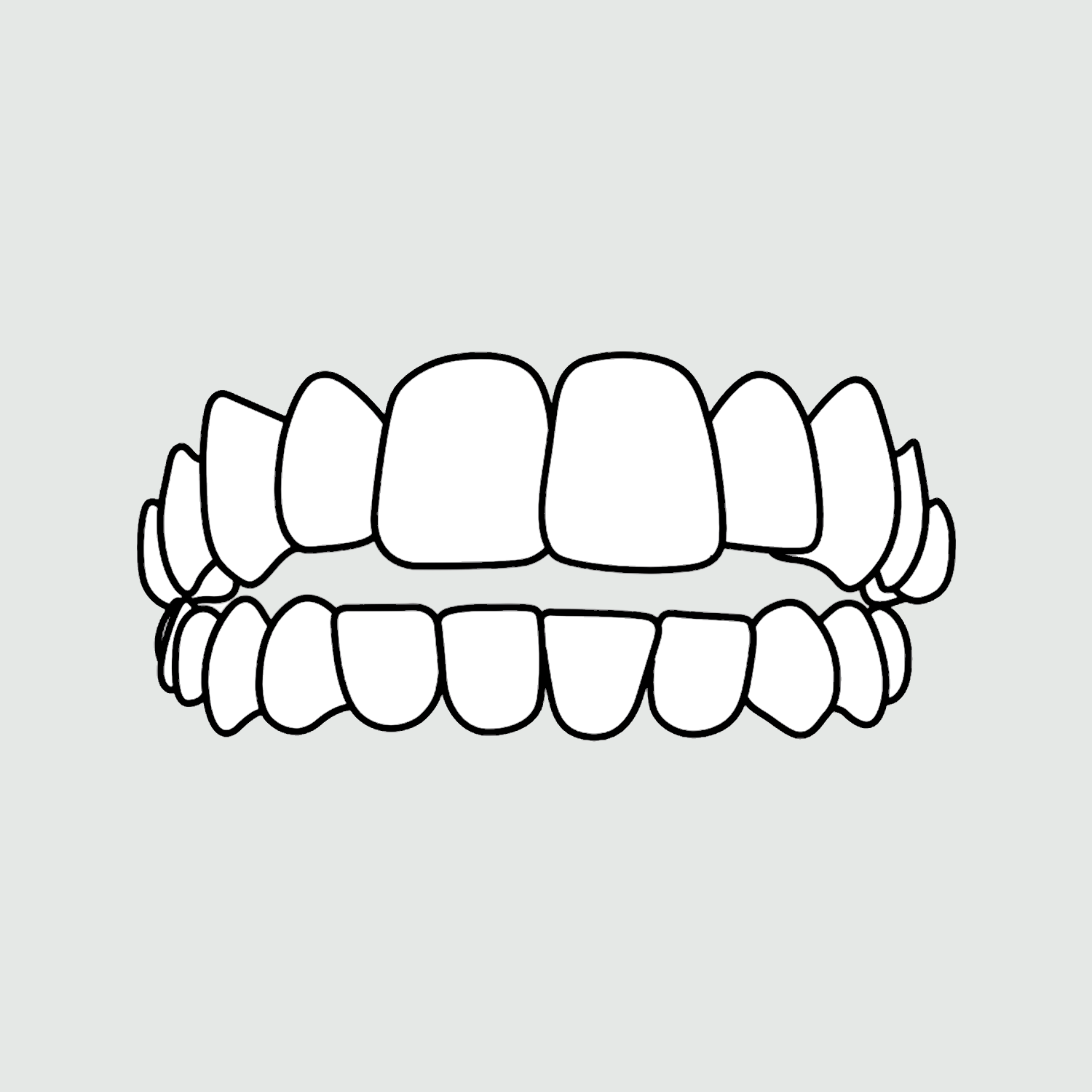 Photo example of a open bite for Invisalign's types of treatable cases. 