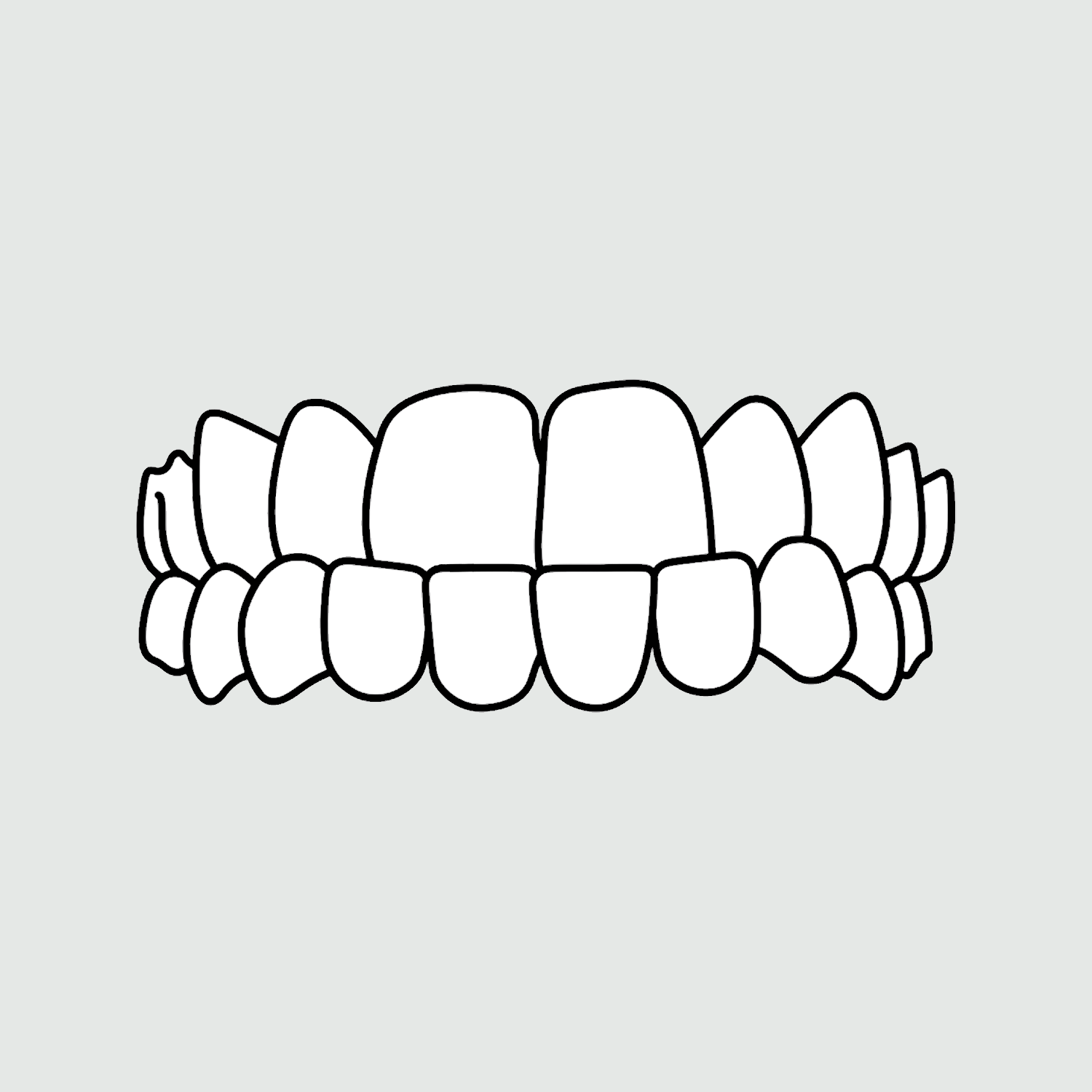 Photo example of a under bite for Invisalign's types of treatable cases. 