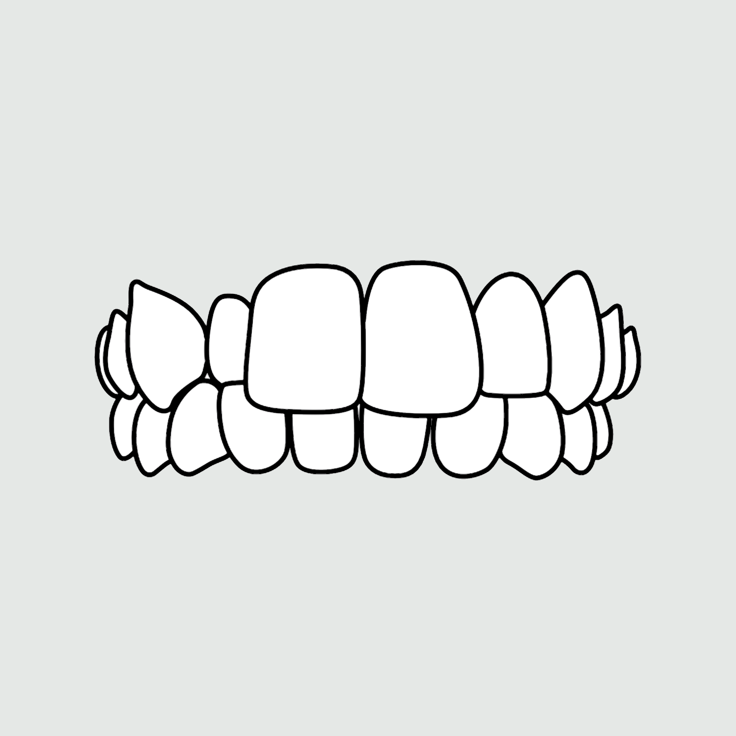 Photo example of a cross bite for Invisalign's types of treatable cases. 
