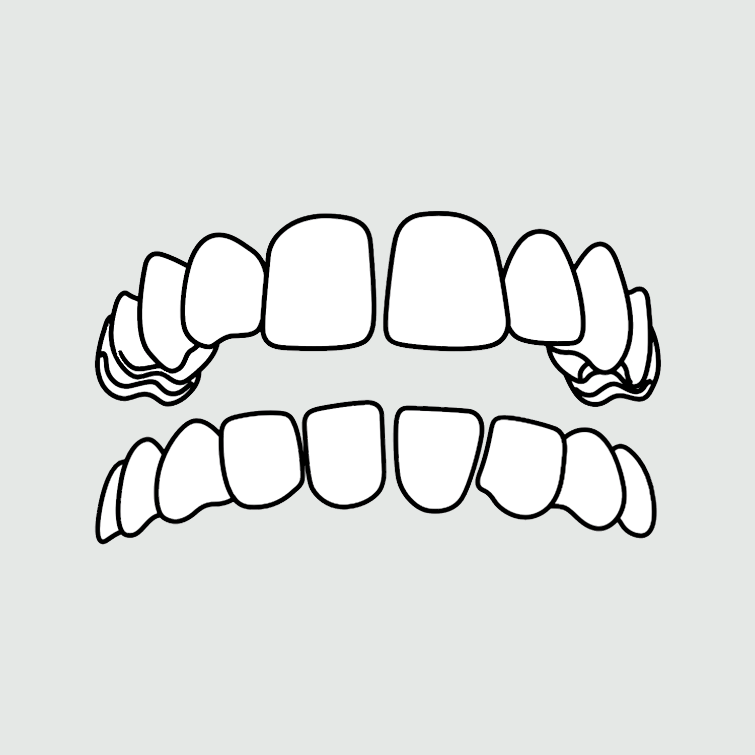 Photo example of spaces between teeth for Invisalign's types of treatable cases. 