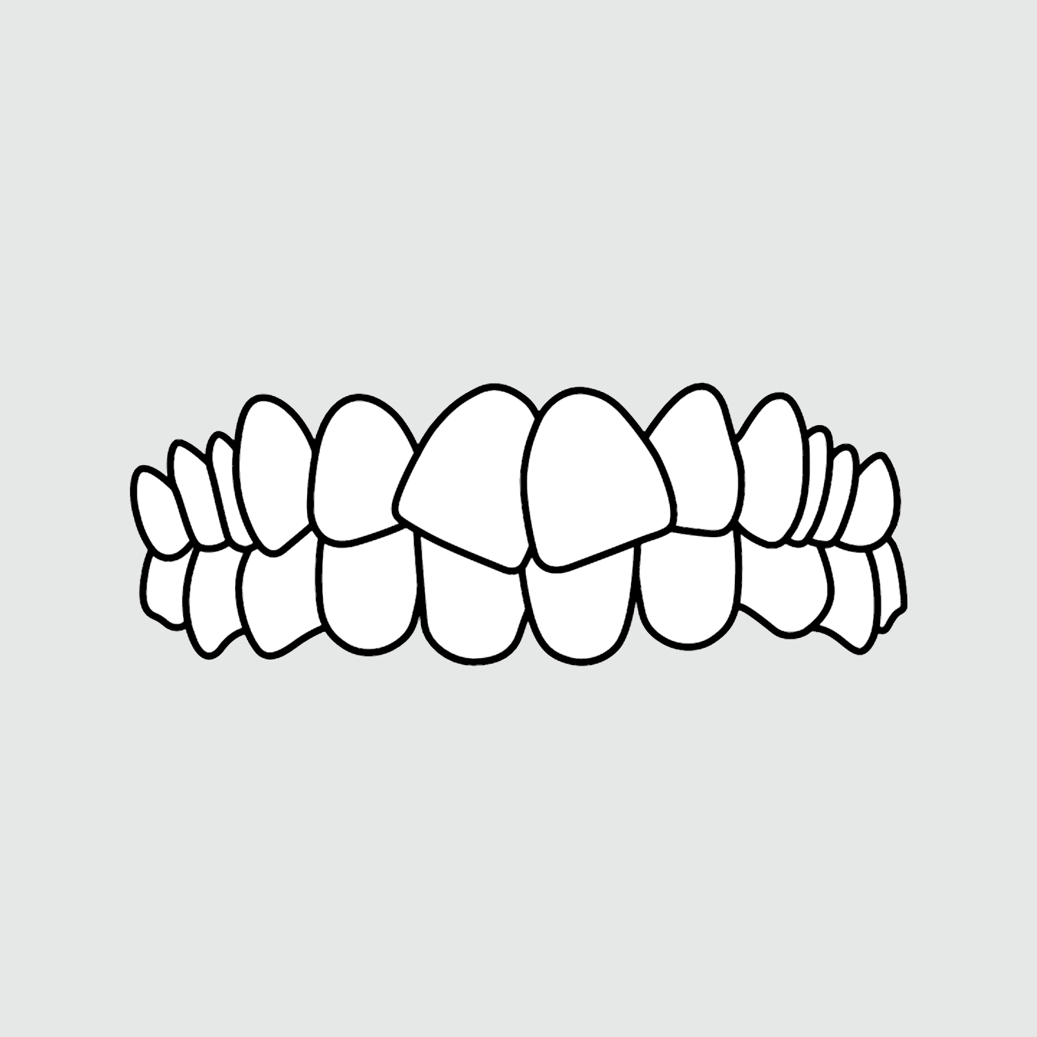 Photo example of teeth crowding for Invisalign's types of treatable cases. 